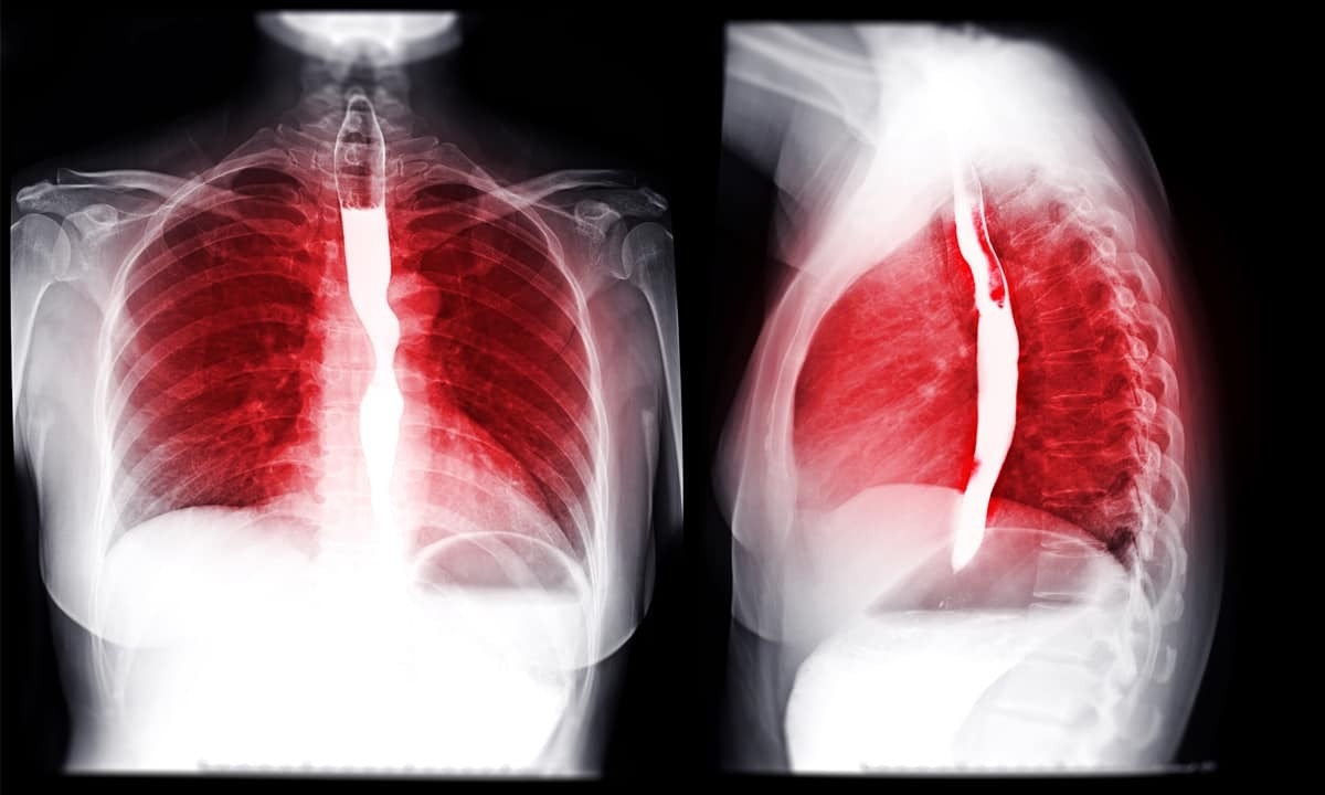 Cary Gastroenterology Associates Why Might I Need A Barium Swallow 