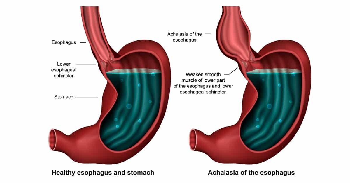 lower esophageal sphincter endoscopy